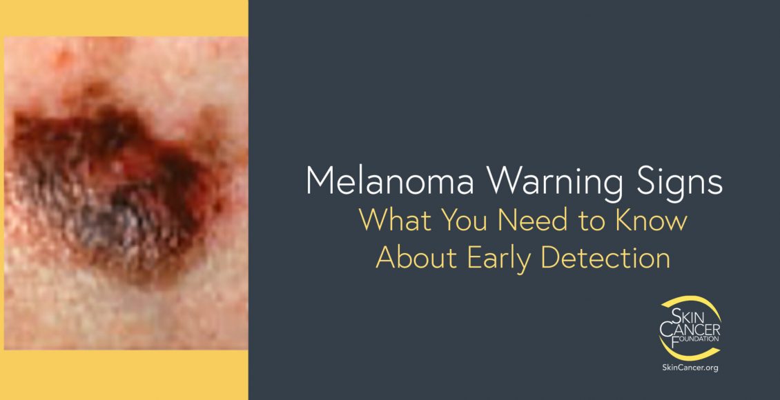 MelanomaWarningSigns2020